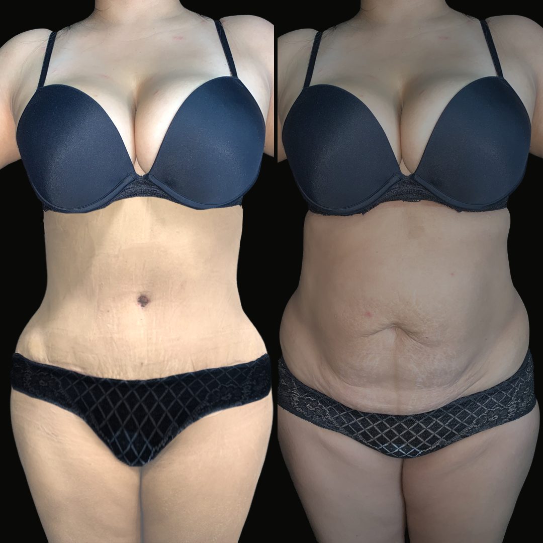 Abdominoplastia — Real·C Clínica, Dr. Marcelo Moncayo, Guayaquil