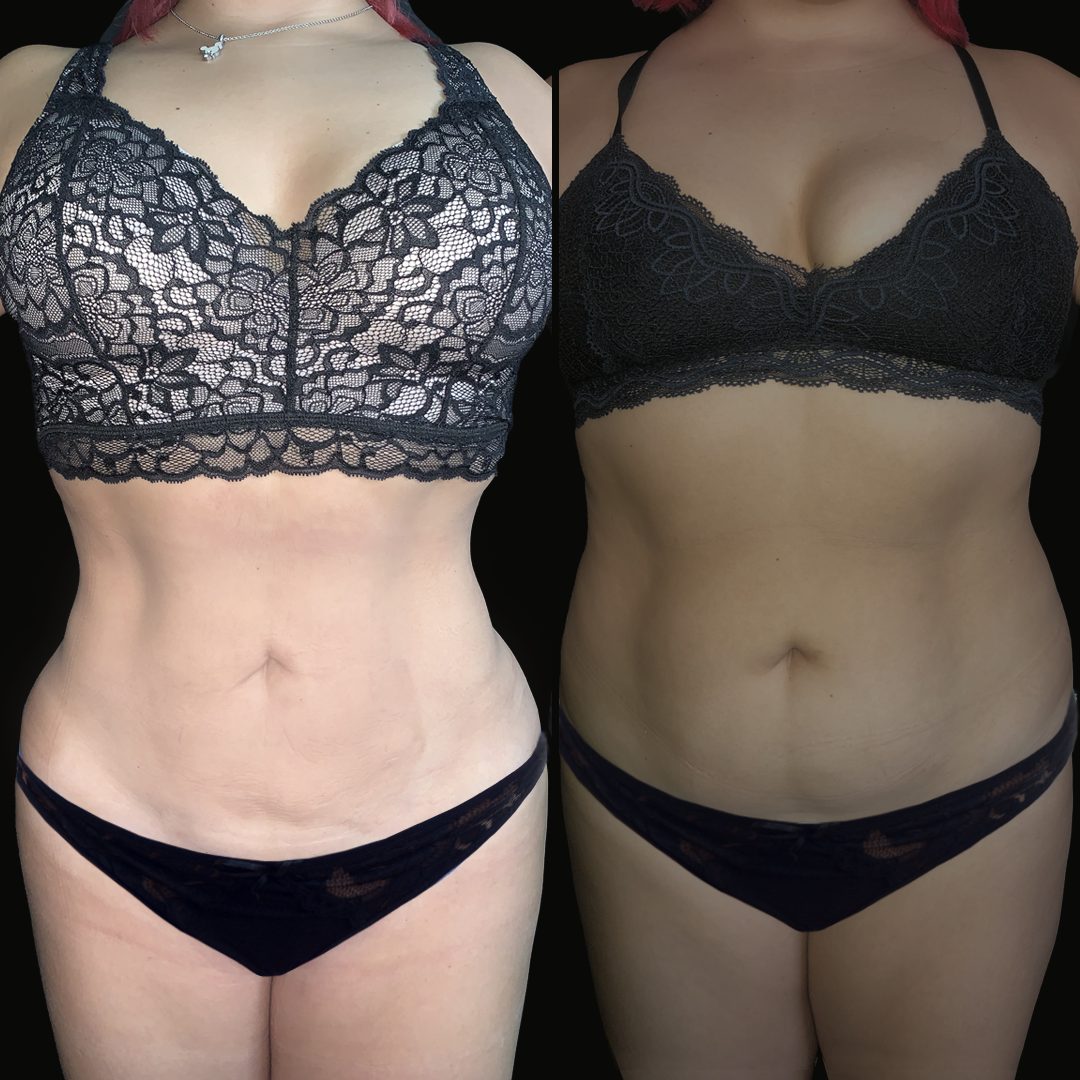 Liposucción — Real·C Clínica, Dr. Marcelo Moncayo, Guayaquil