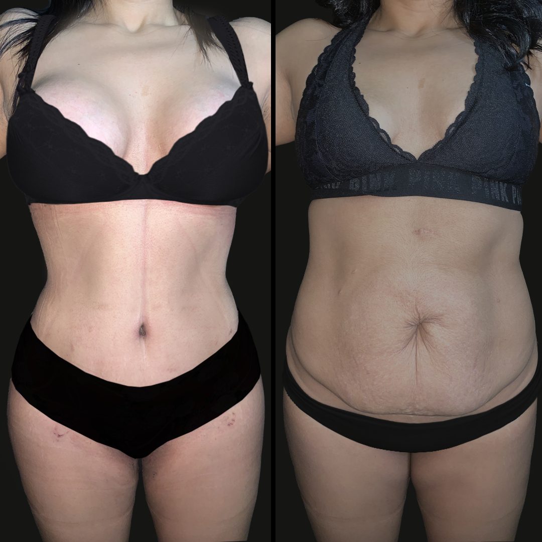 Mommy Makeover — Real·C Clínica, Dr. Marcelo Moncayo, Guayaquil