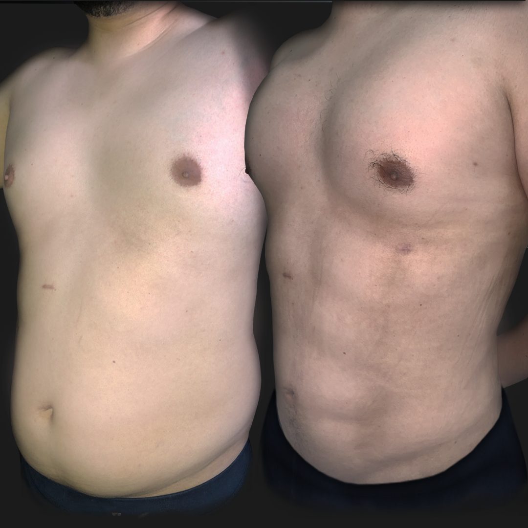 Abdominoplastia — Real·C Clínica, Dr. Marcelo Moncayo, Guayaquil
