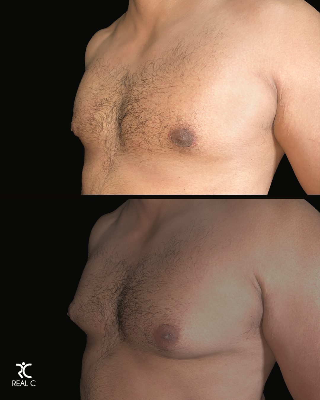 Ginecomastia — Real·C Clínica, Dr. Marcelo Moncayo, Guayaquil