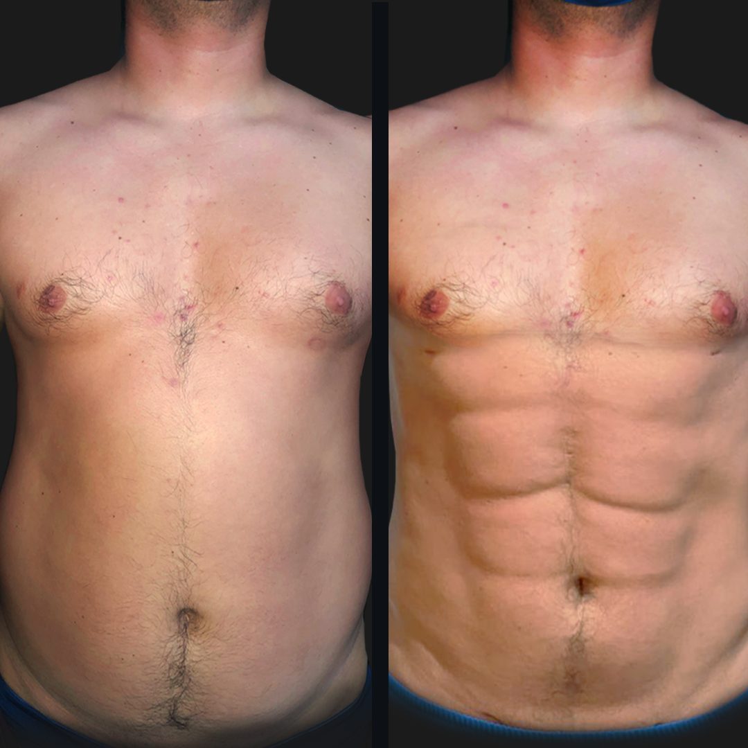 Lipo HD — Real·C Clínica, Dr. Marcelo Moncayo, Guayaquil