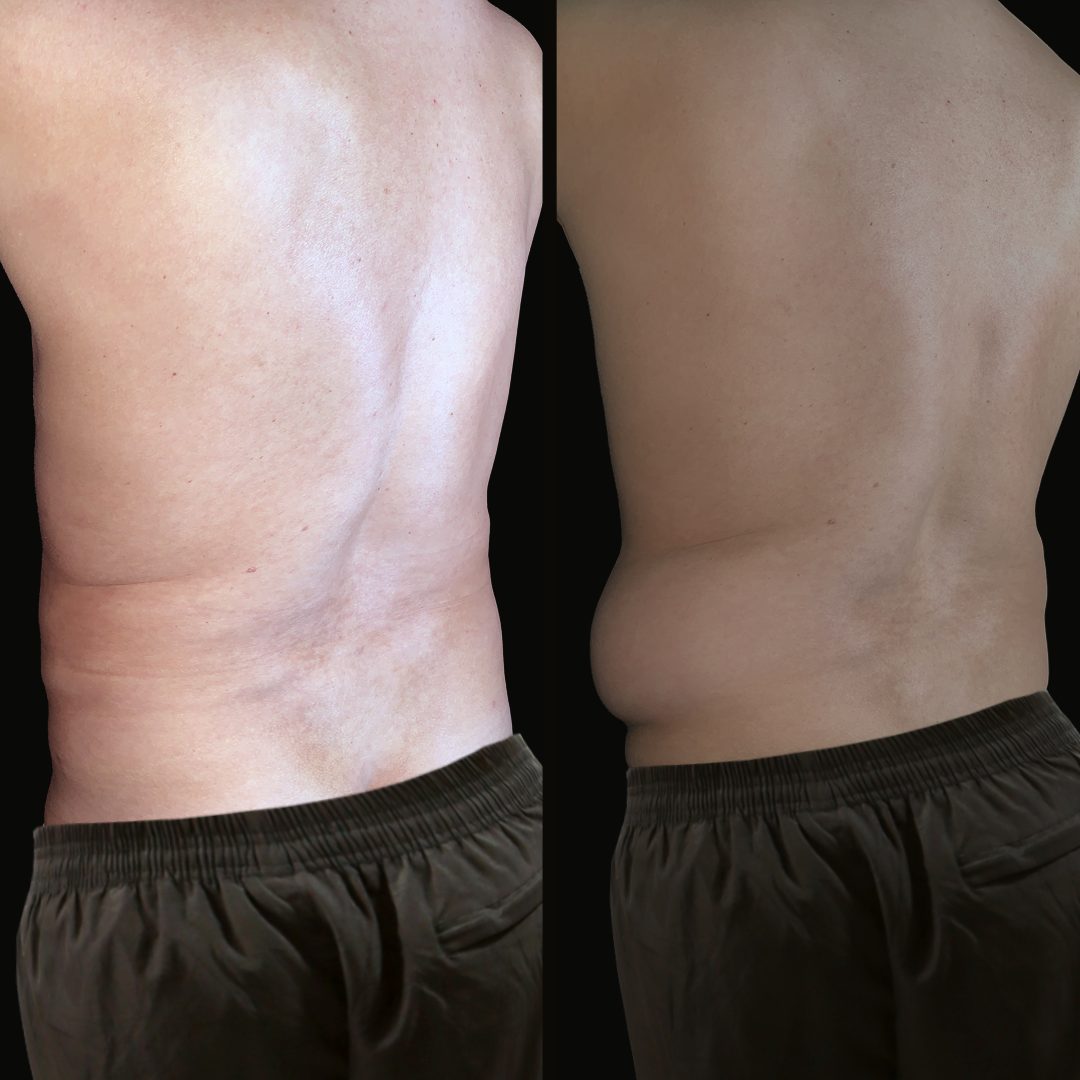 Liposucción — Real·C Clínica, Dr. Marcelo Moncayo, Guayaquil