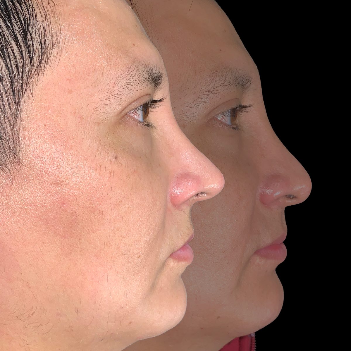 Rinoplastia Correctiva — Real·C Clínica, Dr. Marcelo Moncayo, Guayaquil