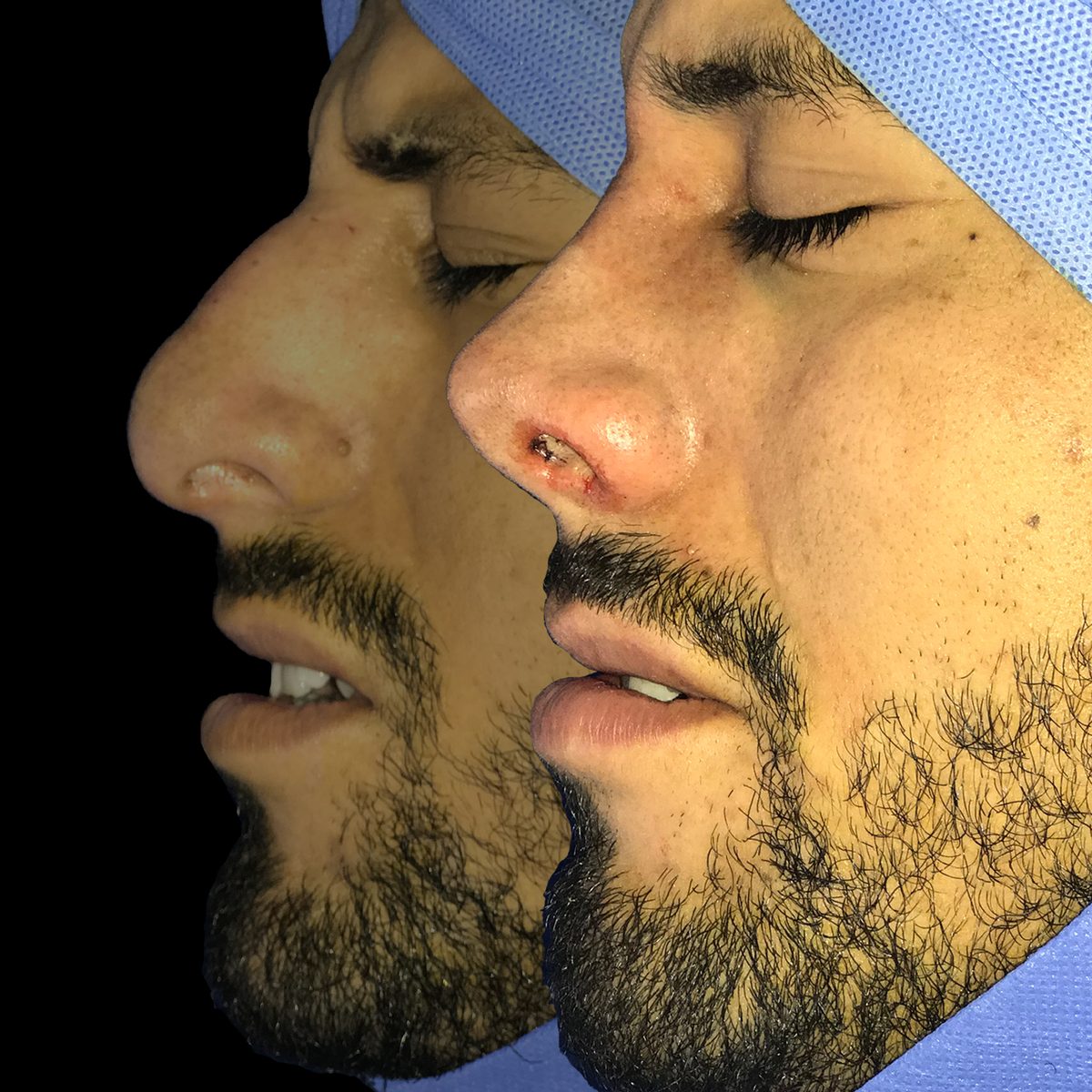 Rinoplastia Estética — Real·C Clínica, Dr. Marcelo Moncayo, Guayaquil