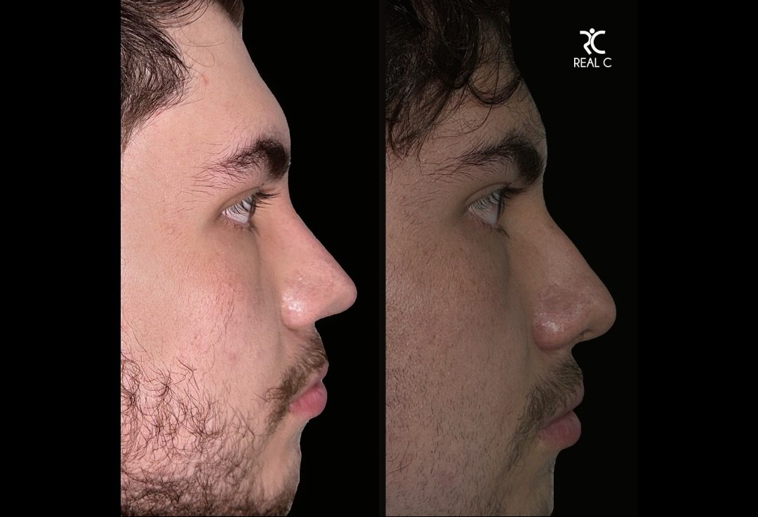 Septorino En Hombre — Real·C Clínica, Dr. Marcelo Moncayo, Guayaquil