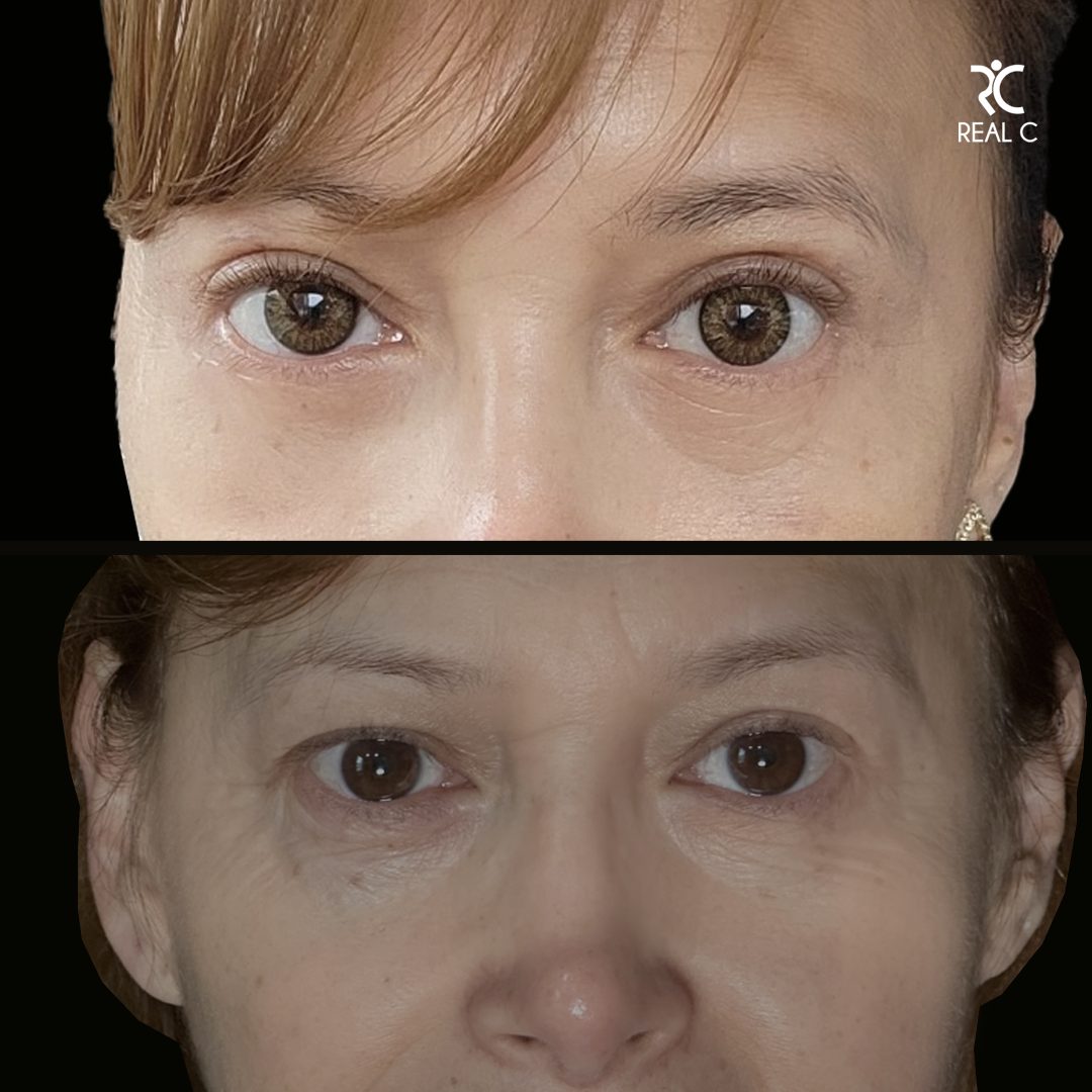 Blefaroplastia — Real·C Clínica, Dr. Marcelo Moncayo, Guayaquil