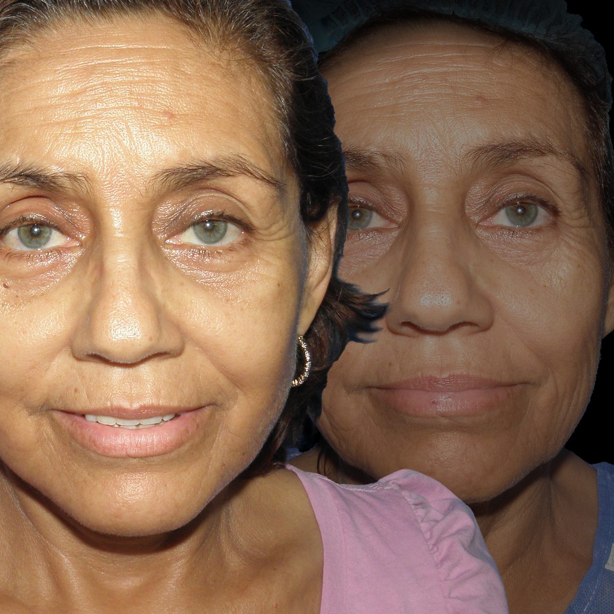 Lifting Facial — Real·C Clínica, Dr. Marcelo Moncayo, Guayaquil