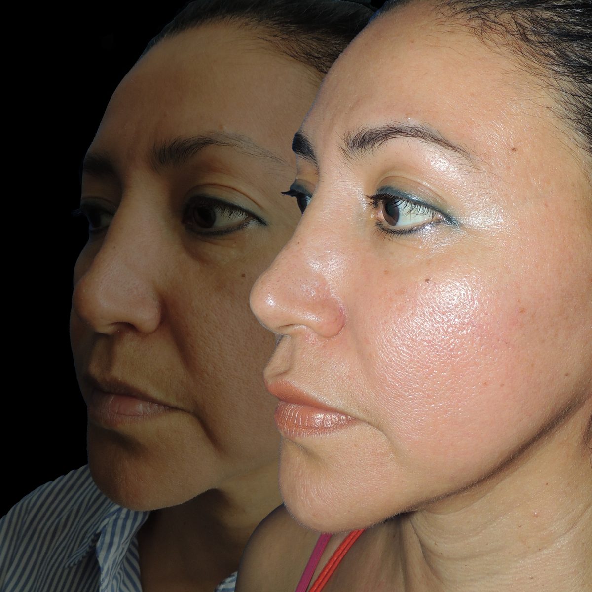 Mini lifting — Real·C Clínica, Dr. Marcelo Moncayo, Guayaquil