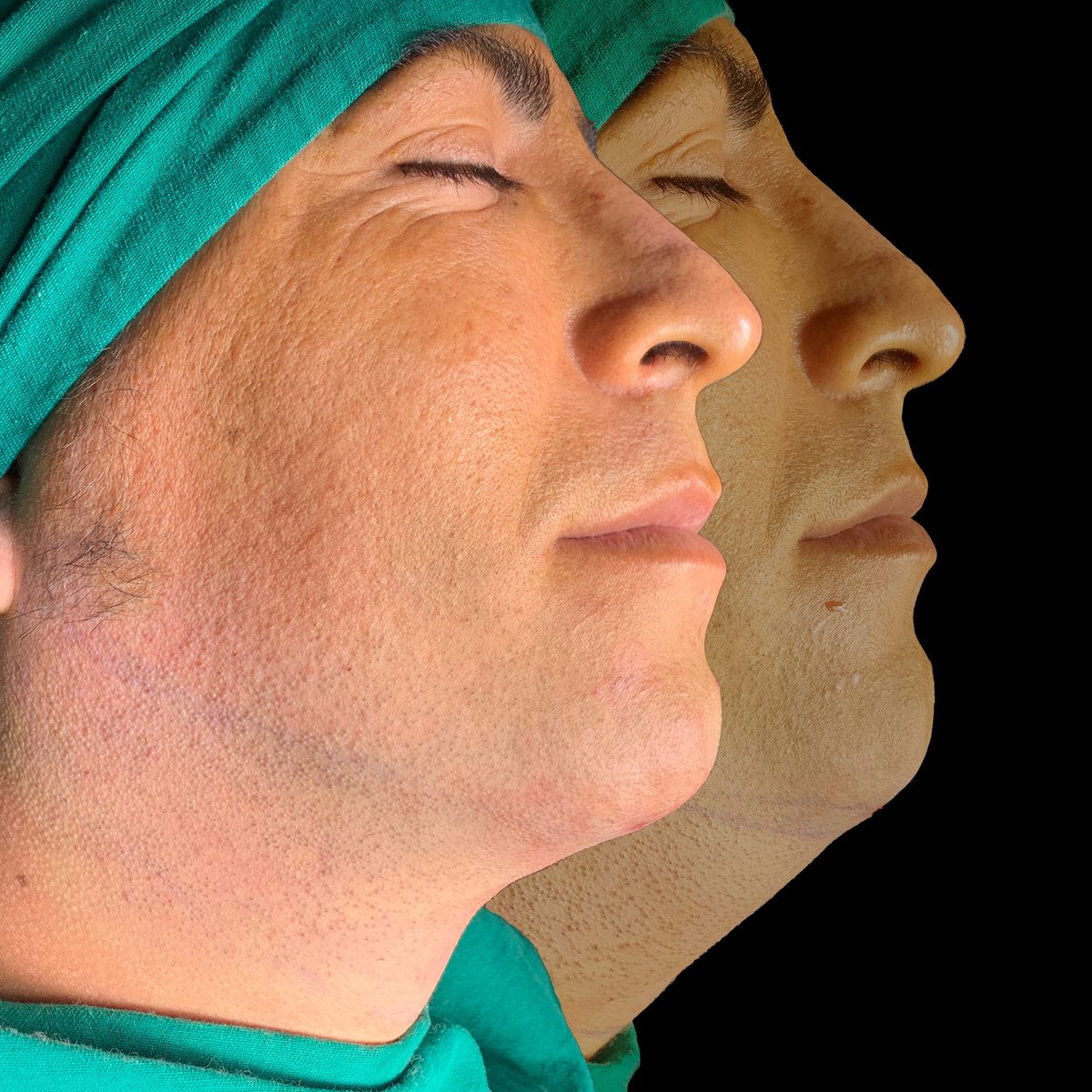Papada — Real·C Clínica, Dr. Marcelo Moncayo, Guayaquil