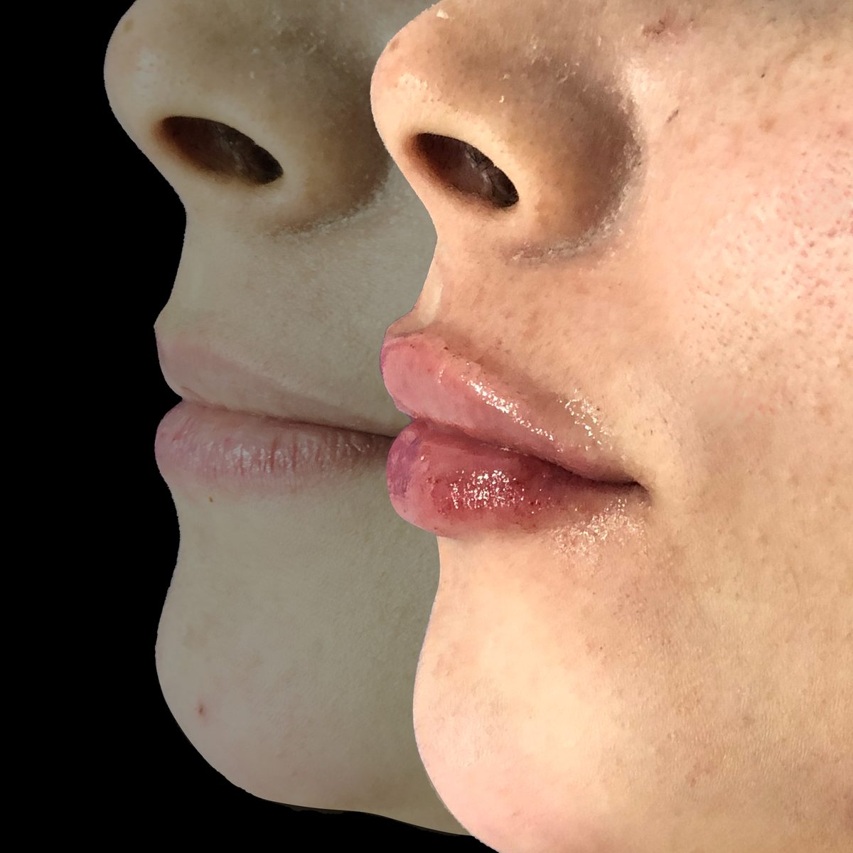 Relleno de labios — Real·C Clínica, Dr. Marcelo Moncayo, Guayaquil
