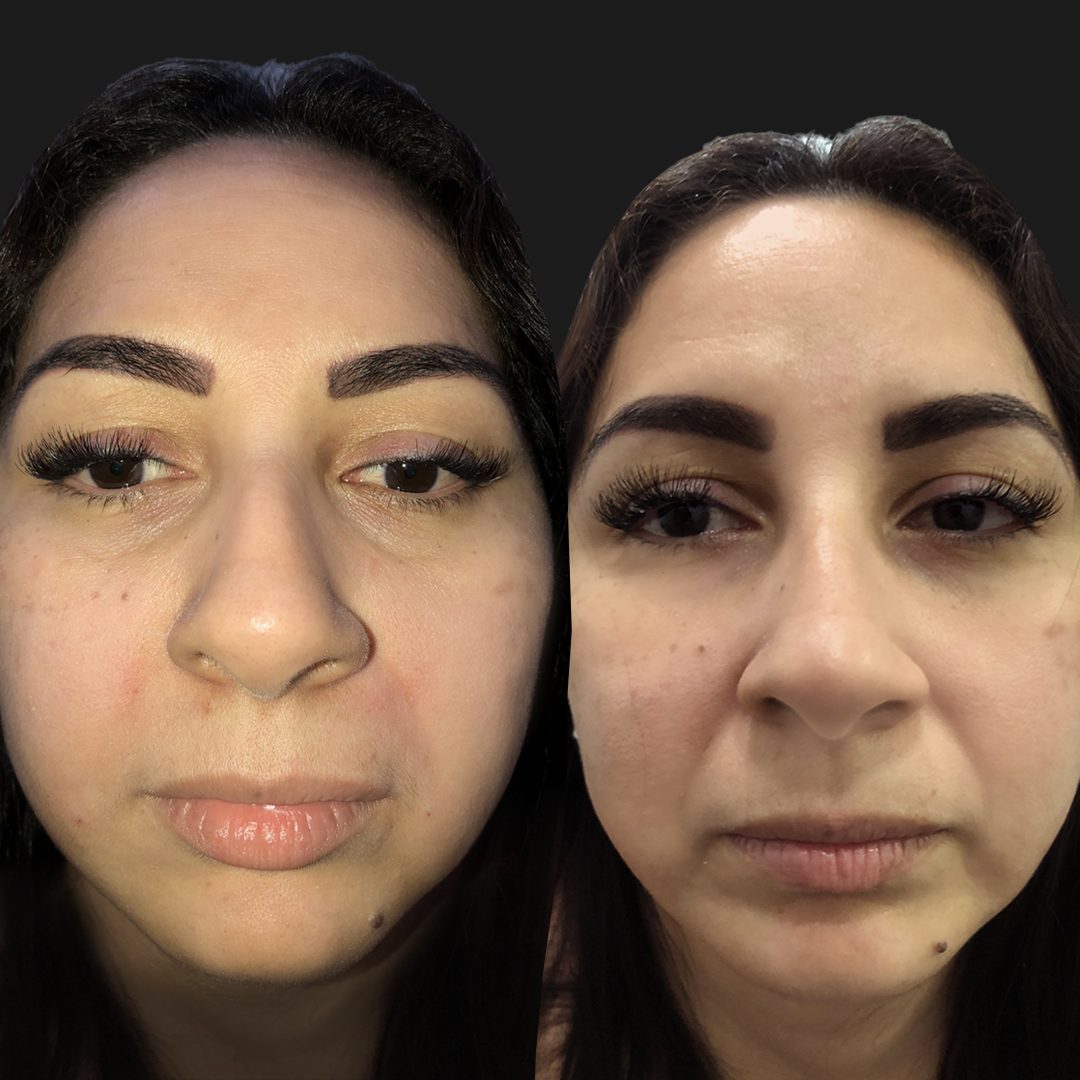 Relleno de Surcos y ojeras — Real·C Clínica, Dr. Marcelo Moncayo, Guayaquil